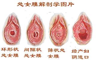 专家全面解析处女膜修复技术